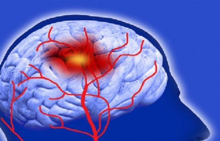 دواء فعال لعلاج الجلطة الدماغية..اليكم التفاصيل!