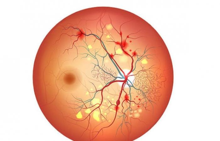 عادات يومية بسيطة تقوي النظر لمرضى السكري