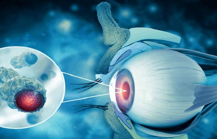 السرطانات التي تُصيب شبكية العين