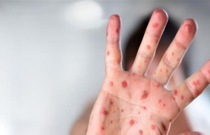 أسوأ تفشّ منذ 30 عاماً.. "الحصبة" تجتاح منطقة أميركية!