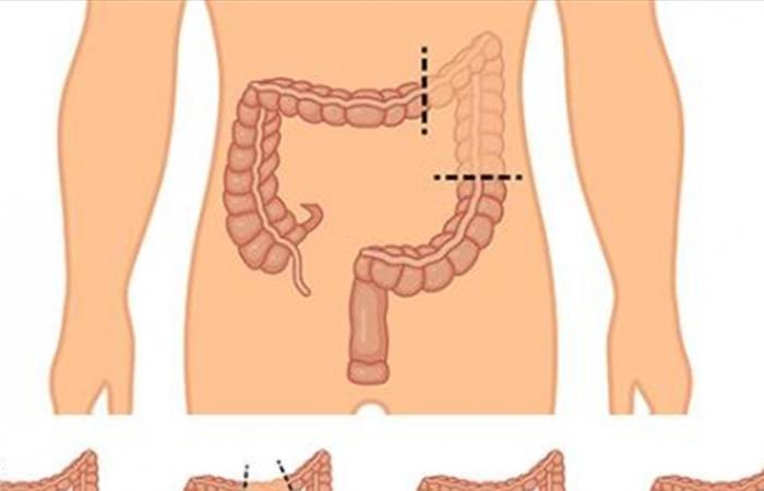أسباب تتطلب استئصال القولون
