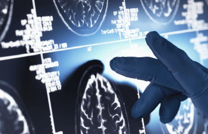 تقنية جديدة قد تحسن وظائف الذاكرة لدى مرضى ألزهايمر