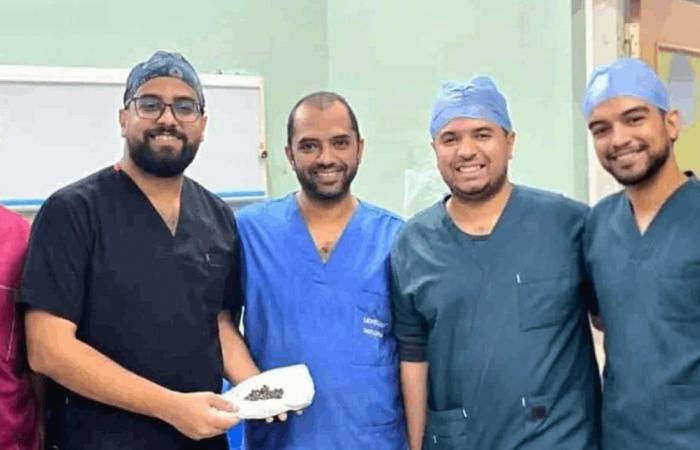 استئصال 58 حصوة من كلية مريض (صور)