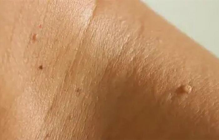 احذر.. الزوائد الجلدية الصغيرة قد تكون مؤشّرًا على مشكلة خفية!