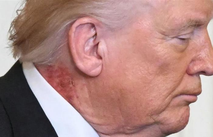 بدت شبيهة بالطفح الجلدي.. "بقعة حمراء" في رقبة ترامب تثير التساؤلات