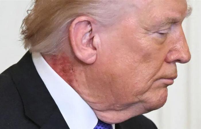 بعد ظهور بقع حمراء على رقبته.. هذا ما قاله طبيب ترامب