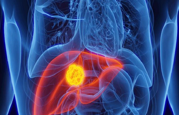 هل الامتناع الكامل عن الكحول يعيد وظائف الكبد حتى في حالات التليف المتقدم؟ دراسة تجيب