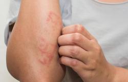 "لاصقة حرارية" تقاوم سرطان الجلد.. كيف ذلك؟