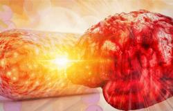 أمل جديد لمرضى السكتات الدماغية المتكررة