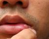 أمراض يمكن اكتشافها من خلال بعض العلامات في الفم... ما هي؟