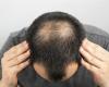 دراسة تكشف.. هذا السبب الرئيسي لتساقط الشعر لدى الرجال