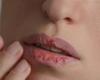 تشققات الشفاه المستمرة.. اكثر من مجرد جفاف